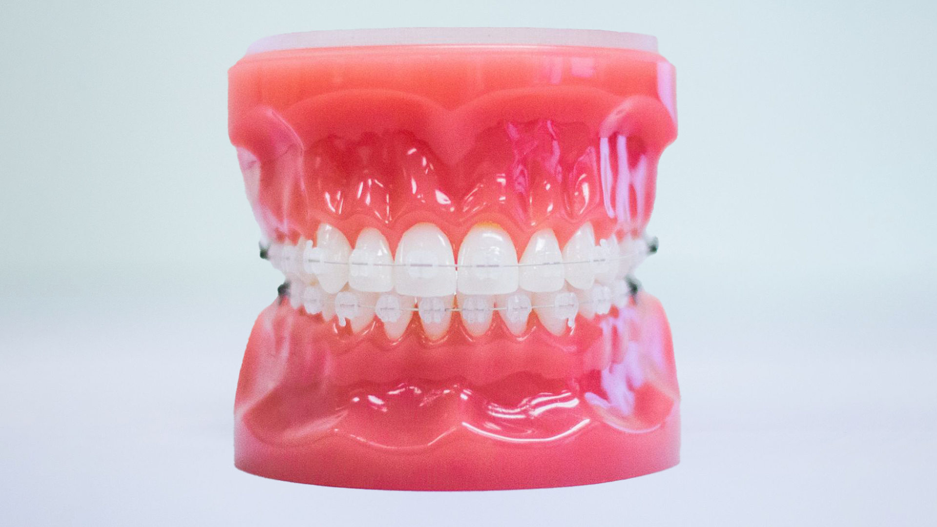 Dental model showing a clear aligner tray fitted over the upper teeth