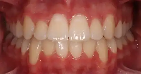 Close-up after treatment showing the upper and lower teeth aligned