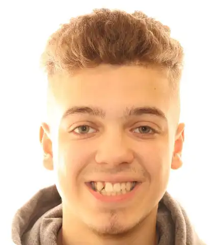 Teenage patient before orthodontic treatment, smiling with crowded and rotated upper front teeth