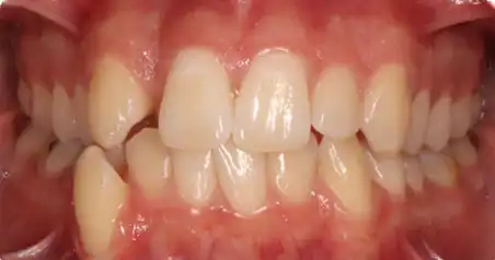 Close-up of the same patient before treatment showing crowding across the upper and lower front teeth