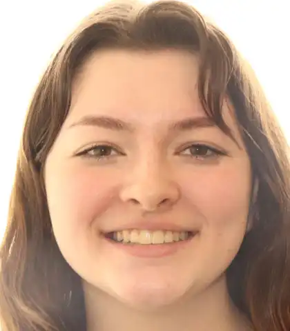 The same patient after treatment with a straight, even smile