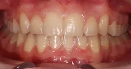Close-up after treatment showing aligned upper and lower arches