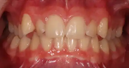 Close-up before treatment showing crowding of the upper front teeth