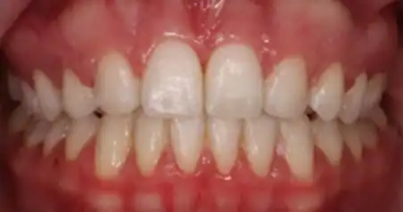 Close-up after treatment showing evenly spaced upper and lower teeth
