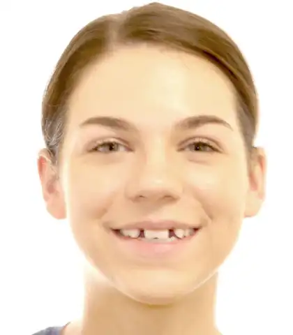 Teenage girl before orthodontic treatment with a visible gap between the upper front teeth