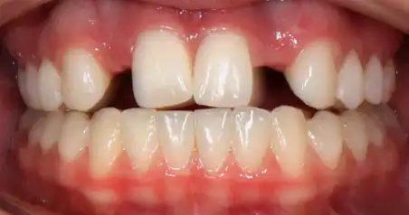 Close-up before treatment showing spacing between the upper front teeth