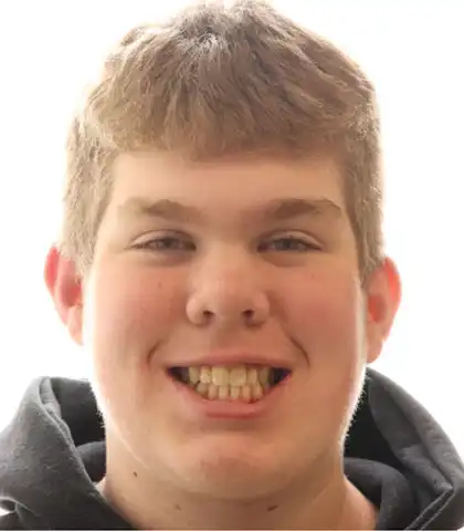 The same young patient after treatment with a corrected, even smile