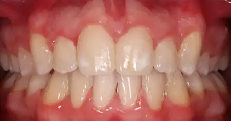 Close-up after treatment showing the upper and lower teeth aligned