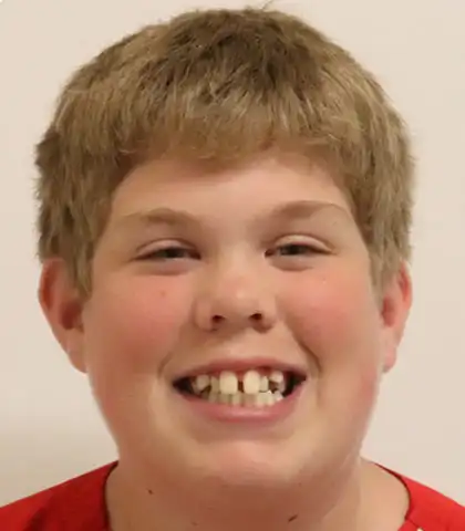 Young boy before orthodontic treatment with protruding and irregular upper front teeth
