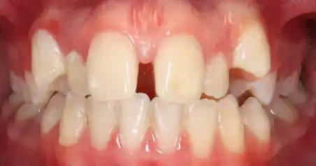 Close-up before treatment showing spacing and irregular alignment of the upper teeth