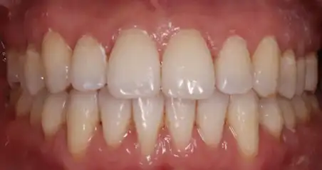 Close-up after treatment showing aligned upper and lower teeth