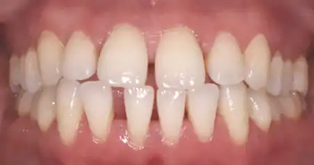 Close-up before treatment showing irregular alignment of the front teeth