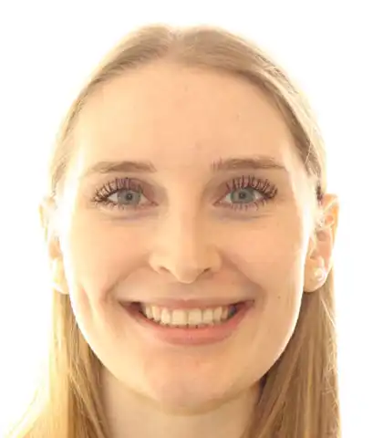 The same patient after treatment with an aligned smile