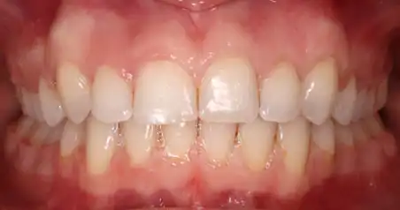 Close-up after treatment showing the crowding resolved