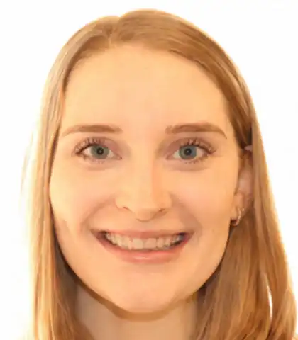 Young woman before orthodontic treatment with crowded upper front teeth