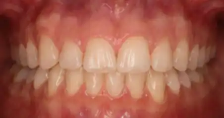Close-up before treatment showing crowding across the upper arch