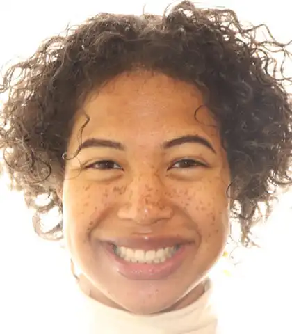 The same patient after treatment with a straight, even smile