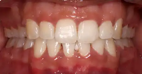 Close-up after treatment showing aligned upper and lower arches