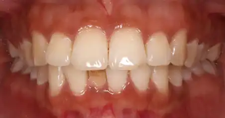 Close-up before treatment showing irregular alignment of the upper teeth
