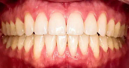 Close-up after treatment showing the upper and lower teeth evenly spaced and aligned