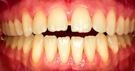 Close-up before treatment showing significant spacing between the upper front teeth